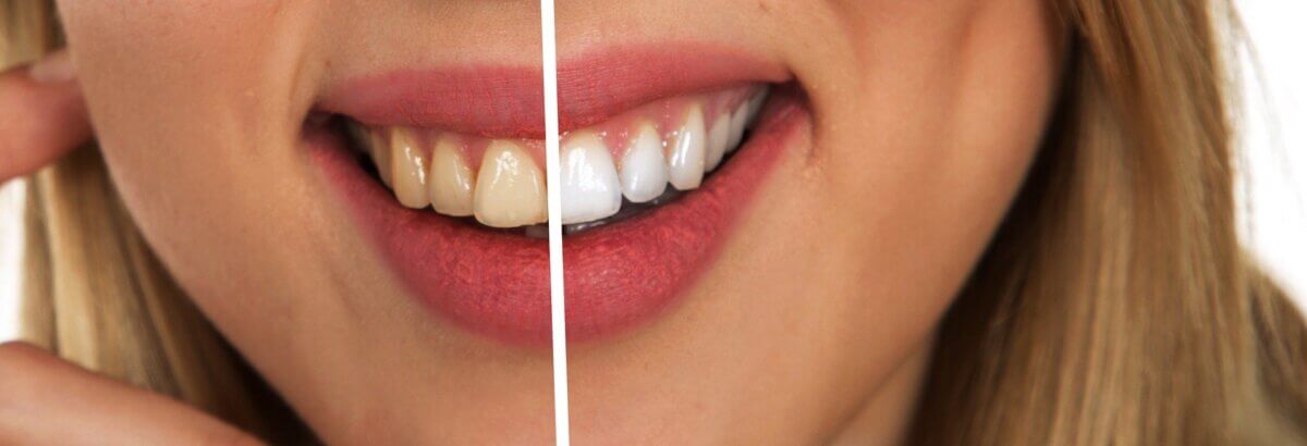 Wybielanie zębów Tomaszów Mazowiecki Al-Dent klinika dentystyczna