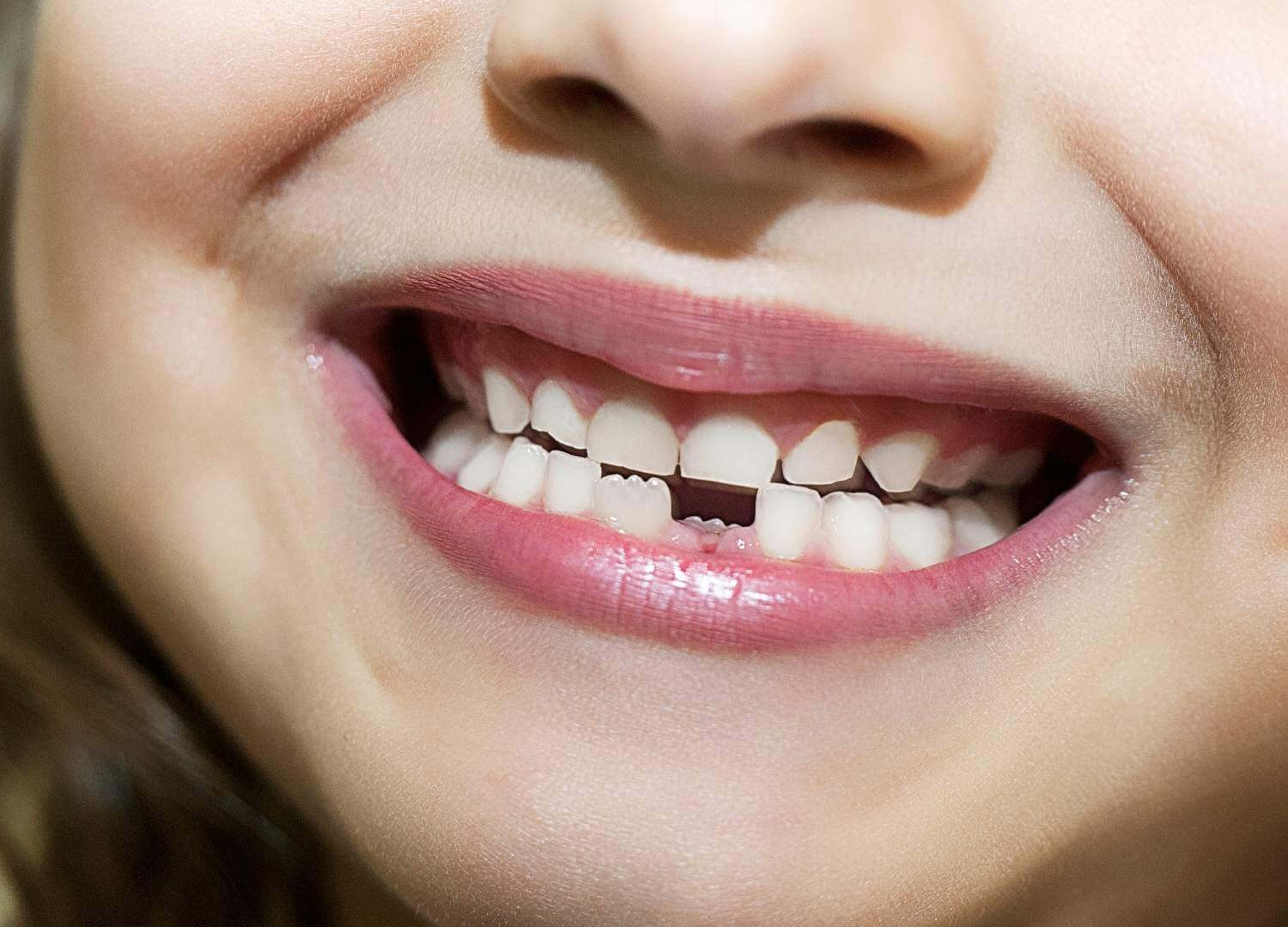 Read more about the article Efekt Godona, czyli przesuwanie się zębów