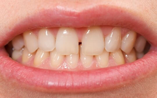 Read more about the article Diastema – czyli przerwa między zębami